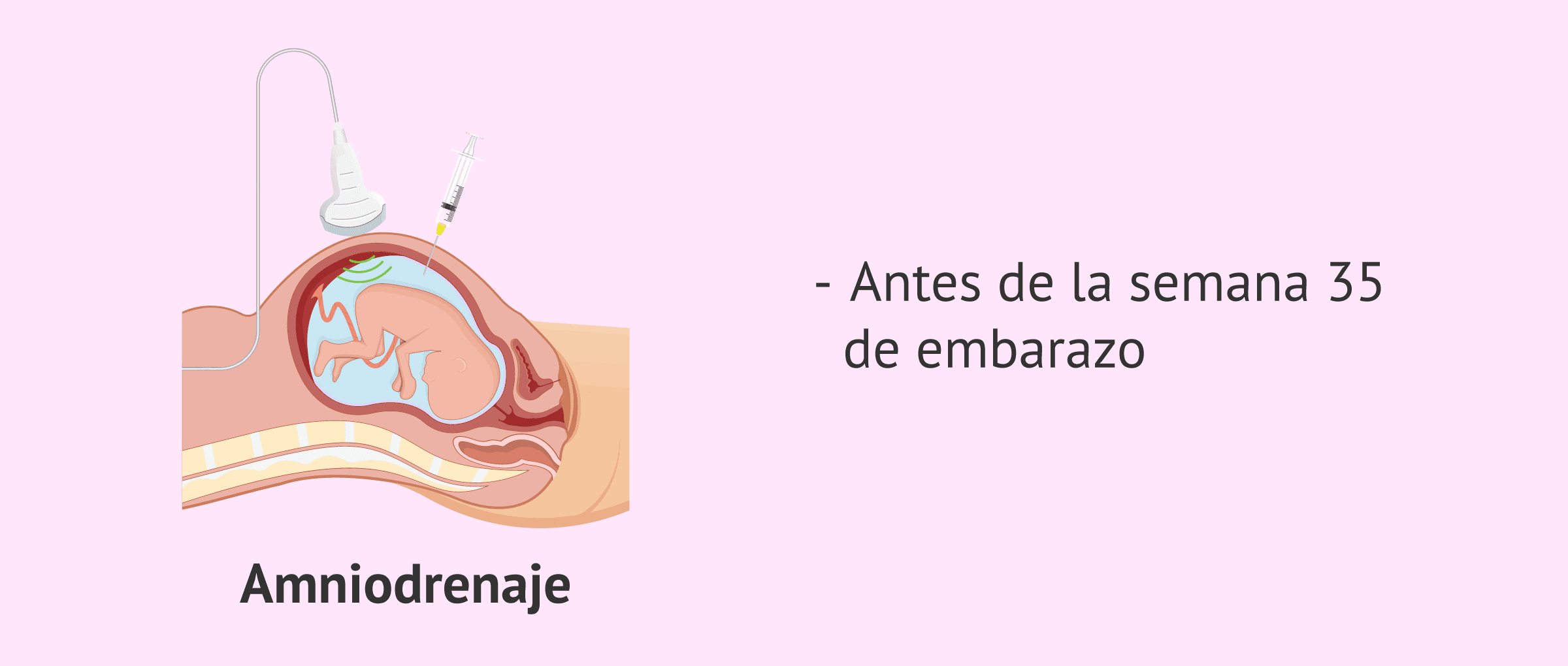 Imagen: ¿Cómo es el amniodrenaje?