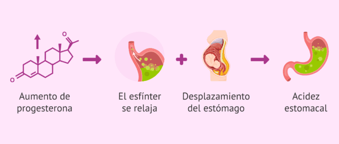 Imagen: Molestias durante el embarazo