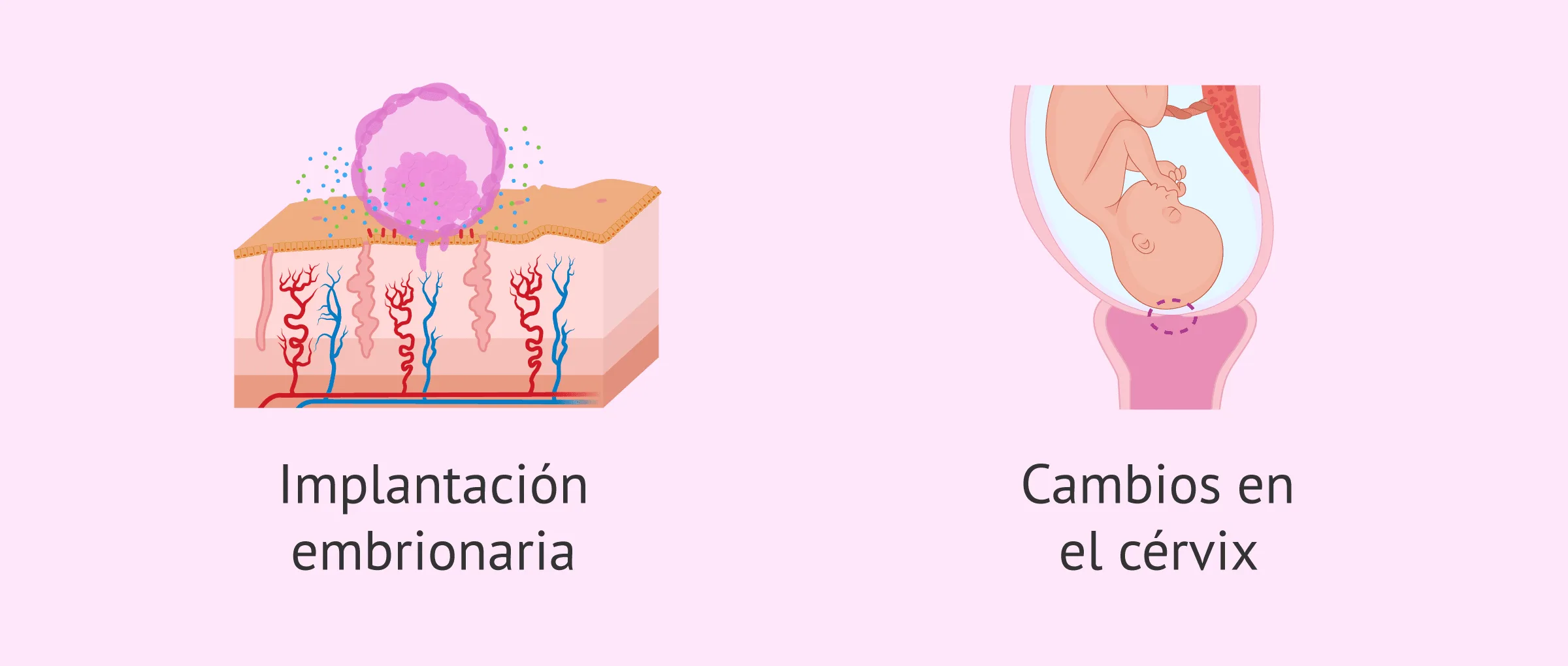 Causas de las hemorragias deciduales en el embarazo