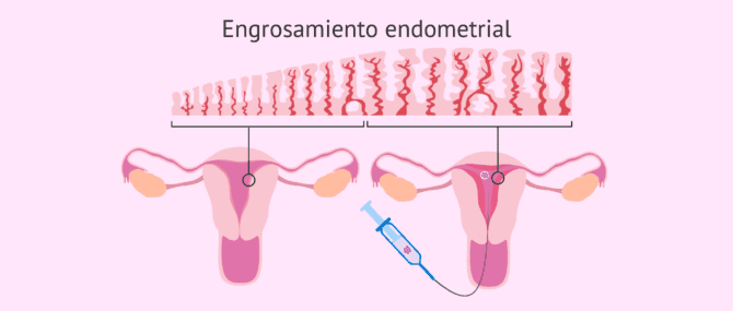 Imagen: Engrosamiento del endometrio para la transferencia embrionaria