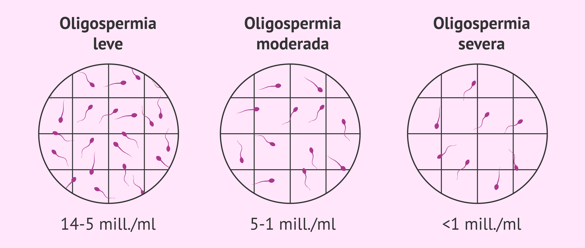 Imagen: Tipos oligospermia