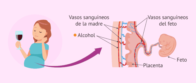 Imagen: Síndrome alcohólico fetal