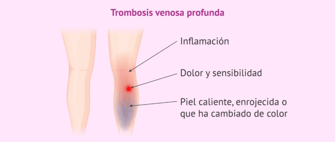 Imagen: Síntomas de coágulo sanguíneo