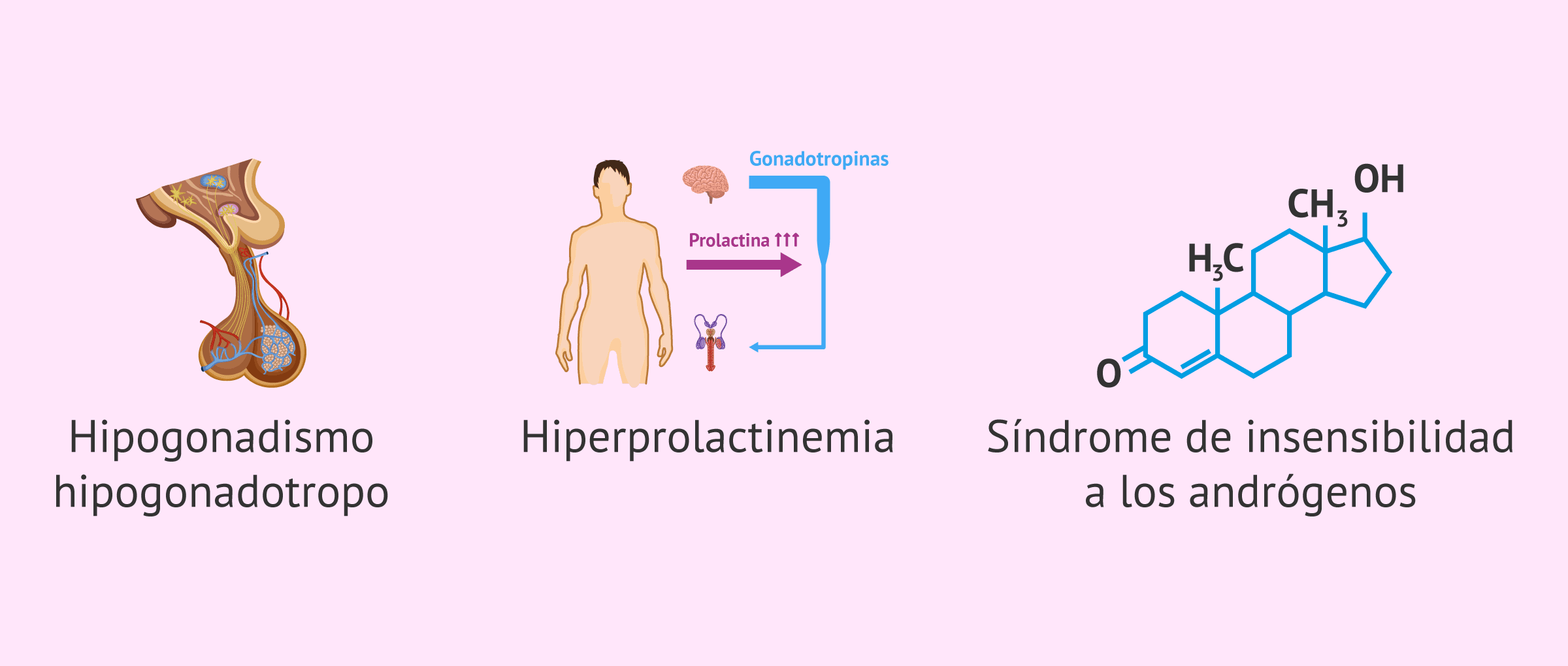 Imagen: Posibles causas pretesticulares de la azoospermia