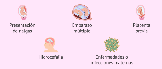 Imagen: ¿Cuándo está indicado programar una cesárea?