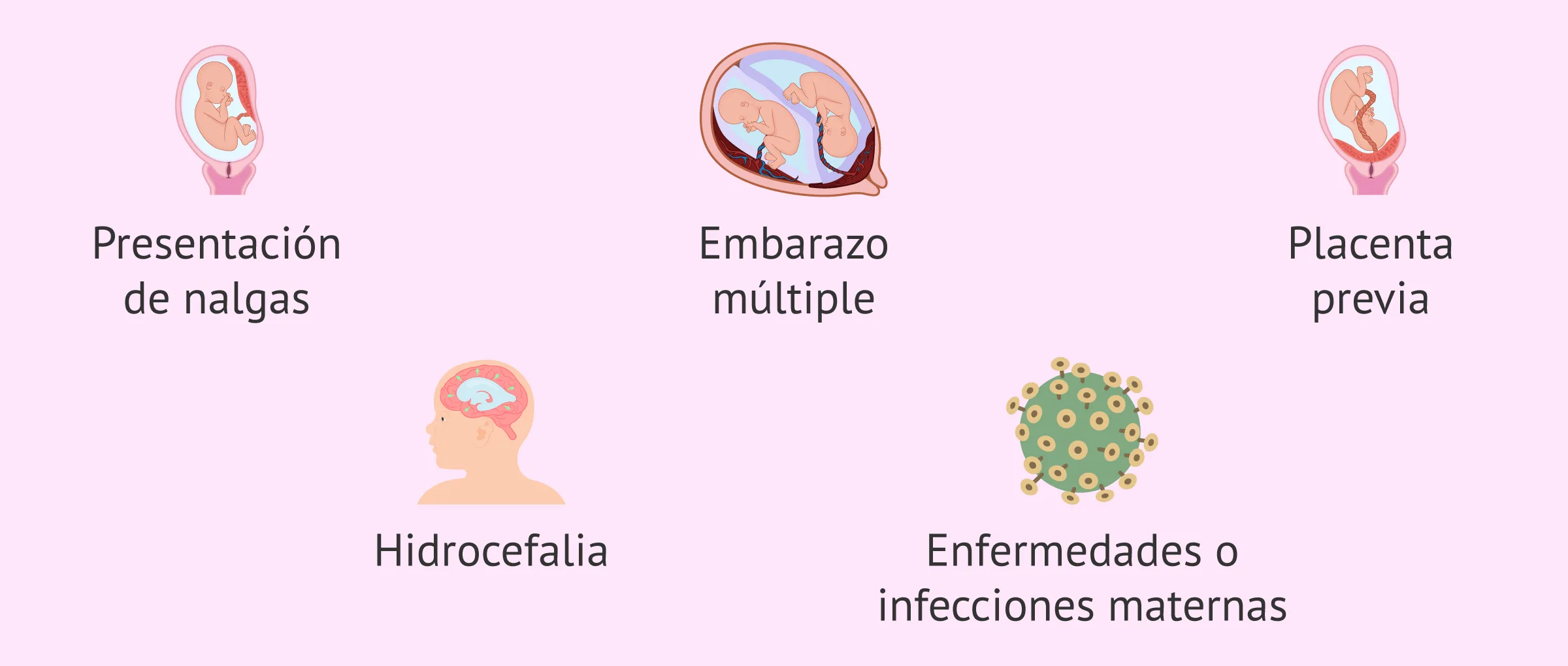 ¿Cuándo está indicado programar una cesárea?