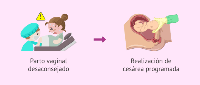 Imagen: ¿Cuándo se realiza una cesárea programada?