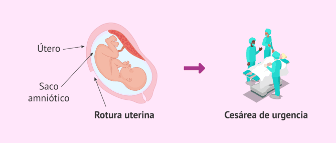 Imagen: Rotura uterina y cesárea de emergencia