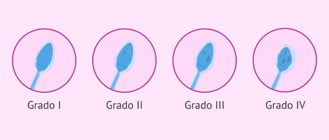 Imagen: Clasificación de los espermatozoides con vacuolas