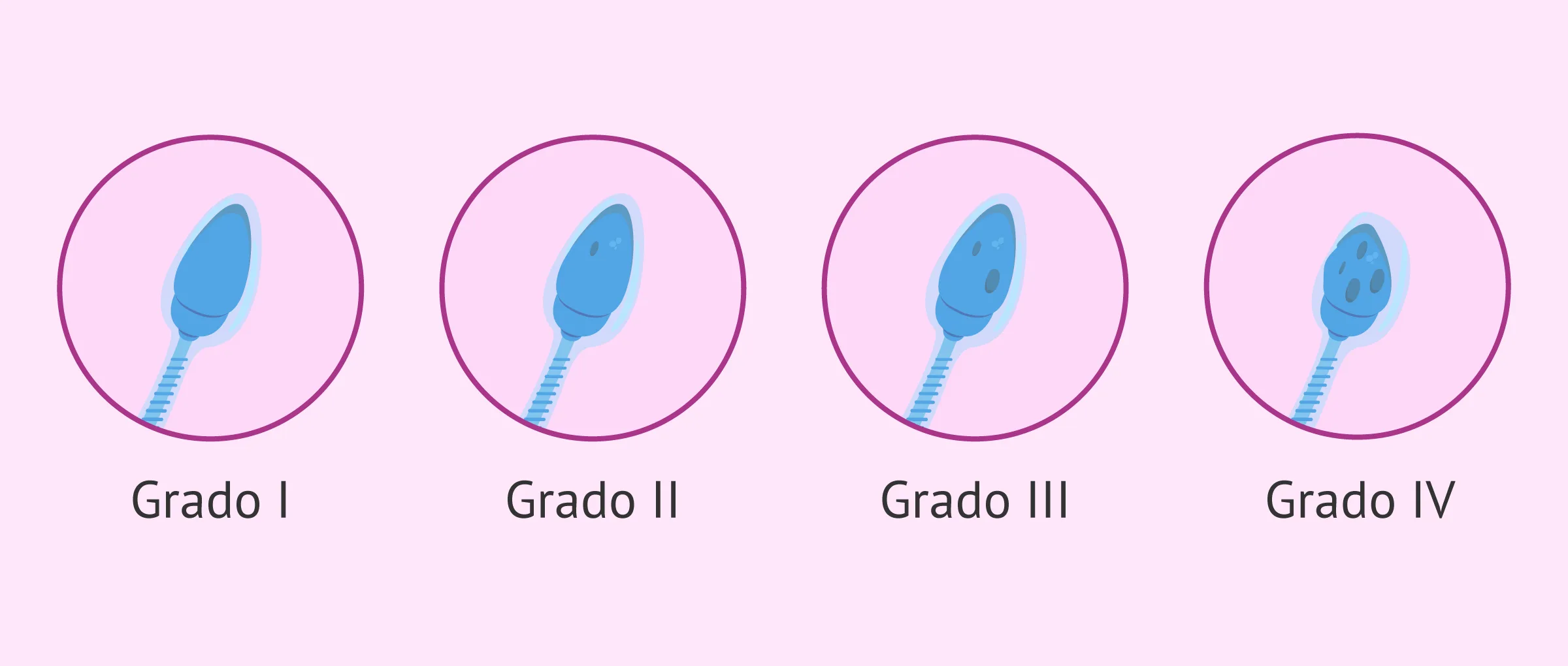 Clasificación de los espermatozoides con vacuolas