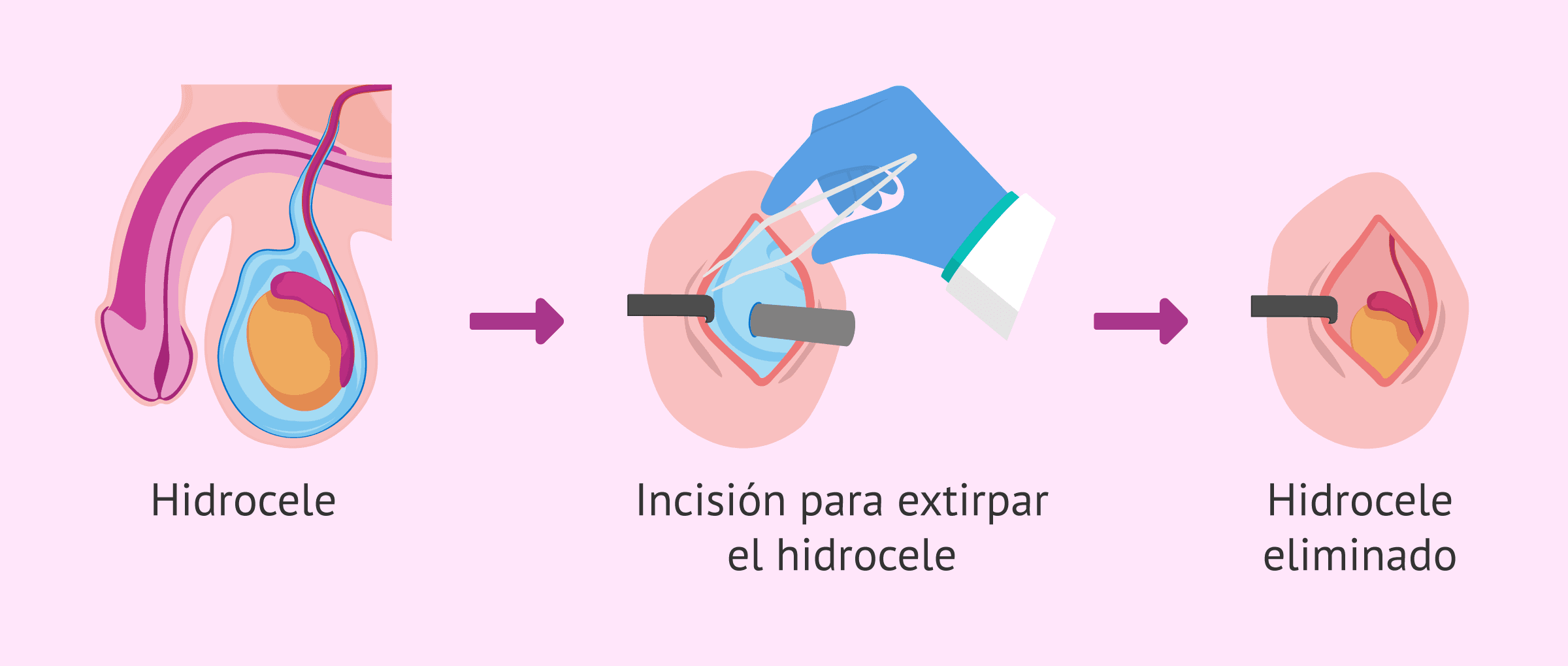 Imagen: hidrocelectomia-glosario