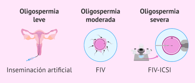 Imagen: Reproducción asistida en pacientes con oligospermia