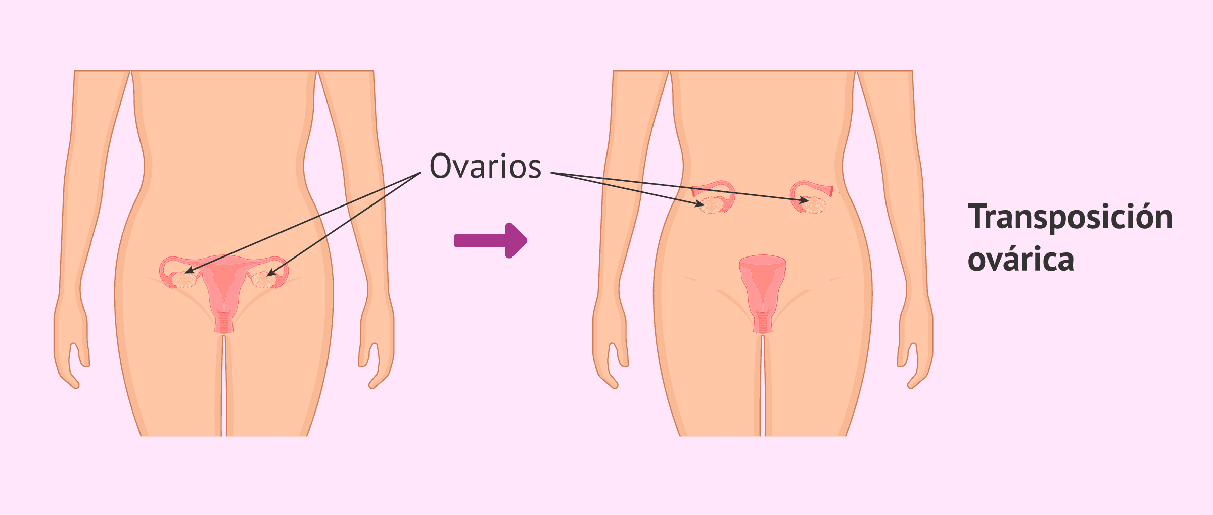 Imagen: ¿En qué consiste la transposición ovárica u ovariopexia?