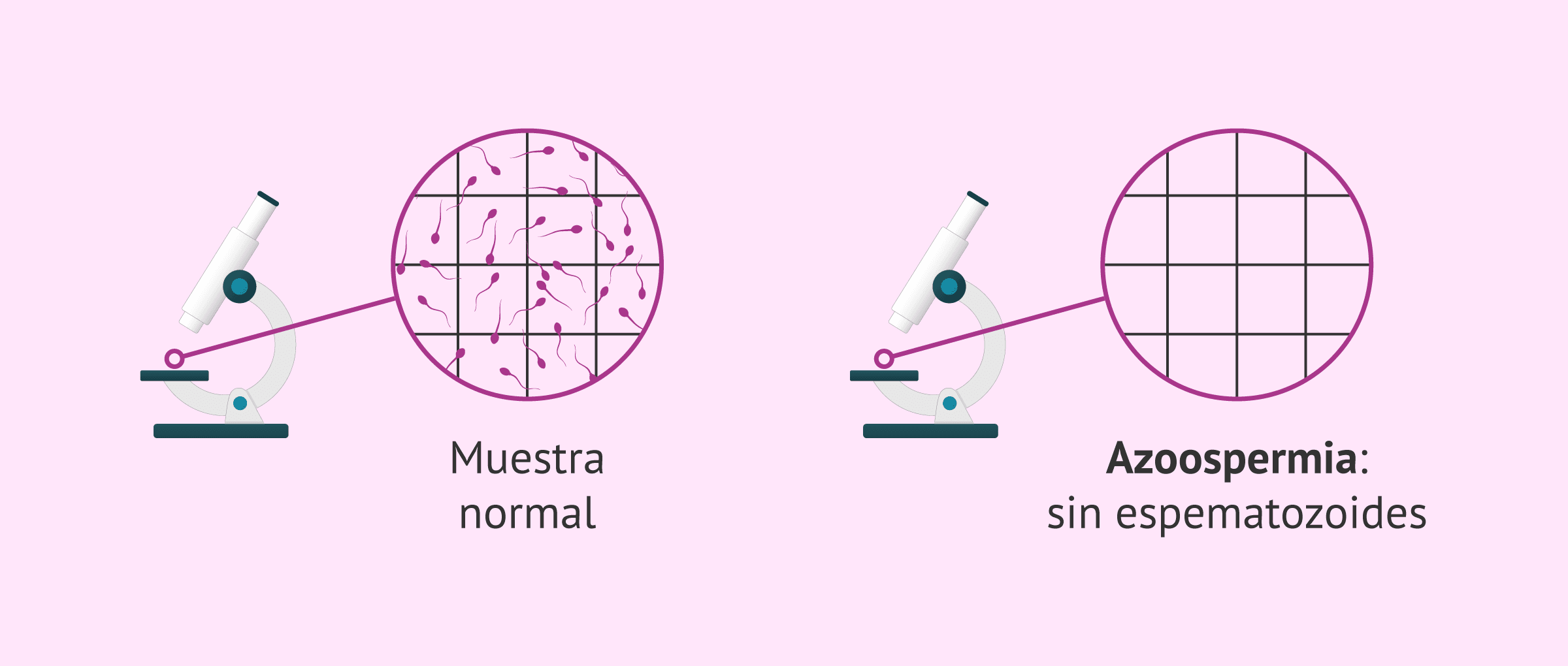 Imagen: ¿Cómo se define la azoospermia?