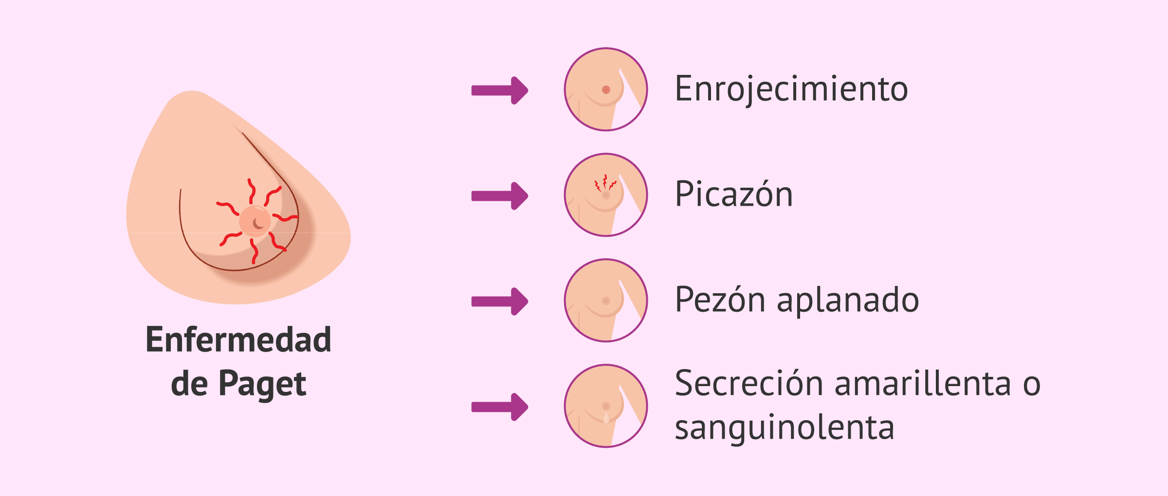 Imagen: Síntomas del cáncer de Paget