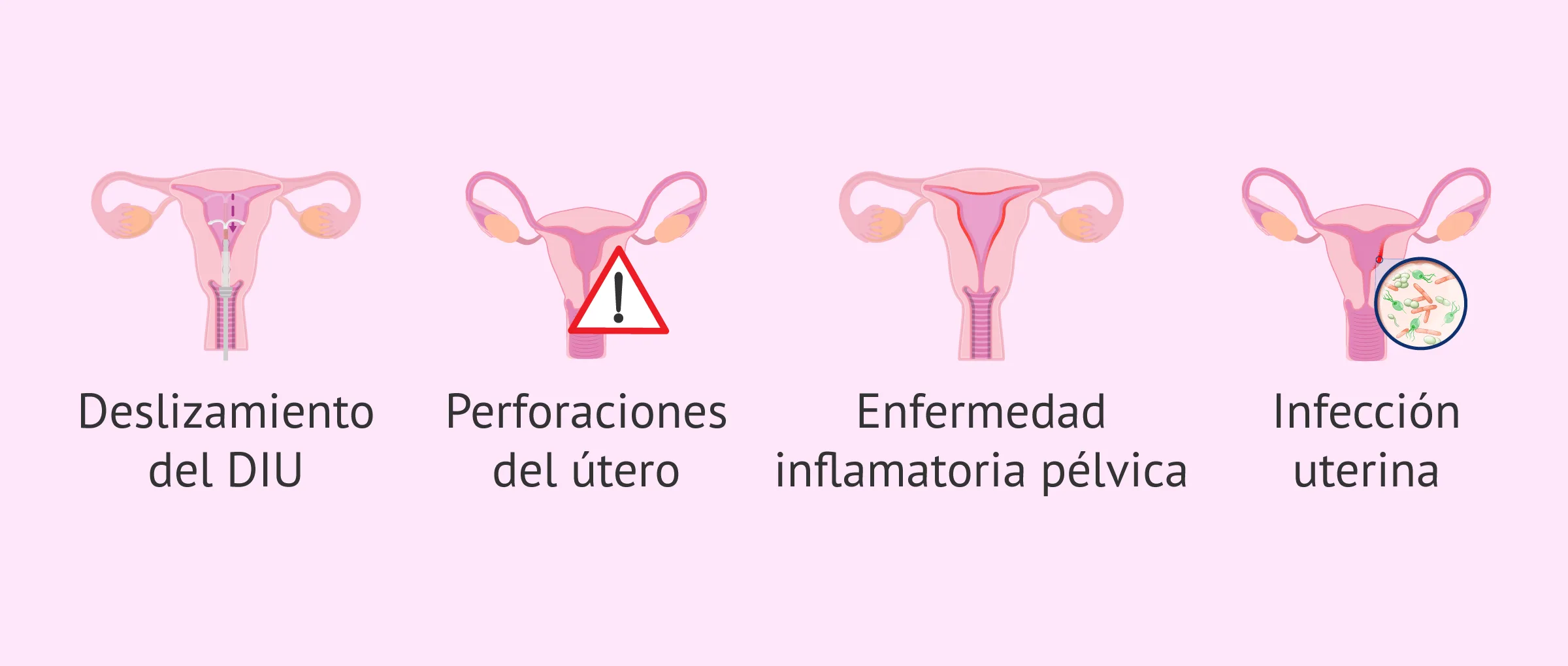 Cómo funciona el DIU? ¿Cuáles son sus ventajas y desventajas?