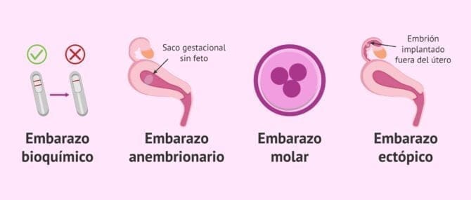 Imagen: Embarazo extrauterino