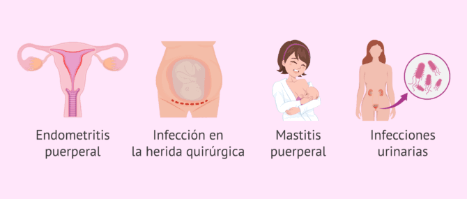 Imagen: Causas de la fiebre puerperal