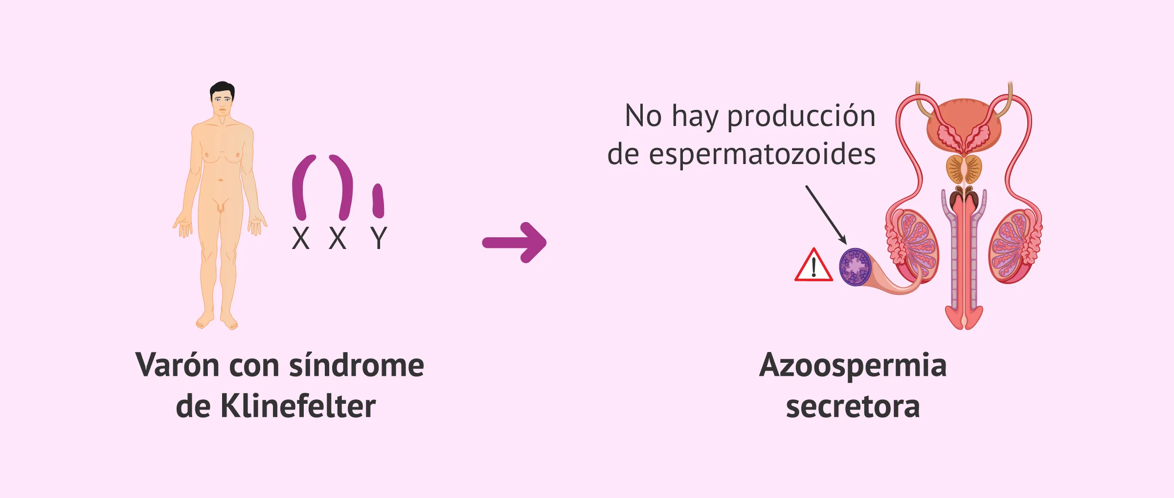 Azoospermia secretora en varones con síndrome de Klinefelter