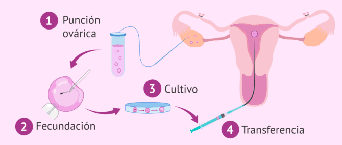 Imagen: FIV con ligadura de trompas