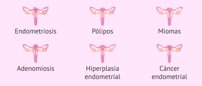 Imagen: Patologías que afectan al endometrio