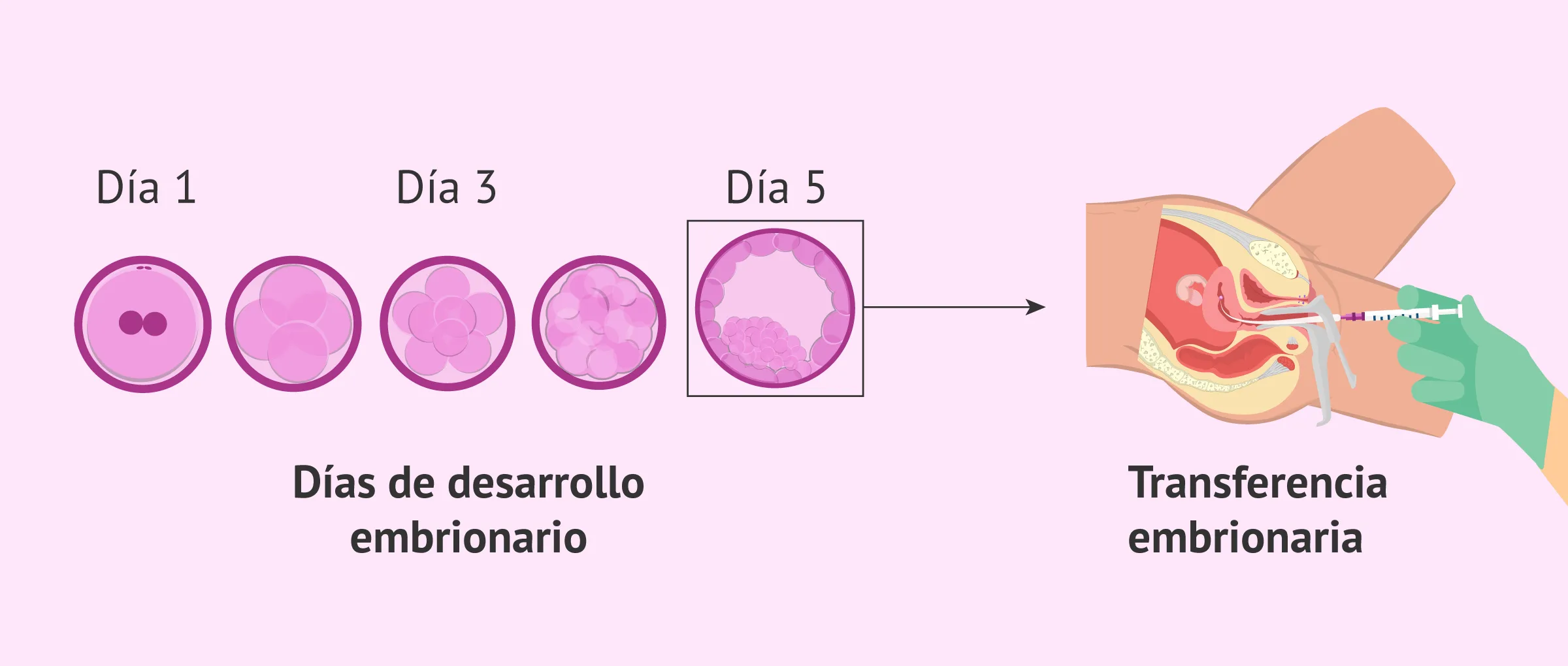 Transferencia embrionaria en ovodonación