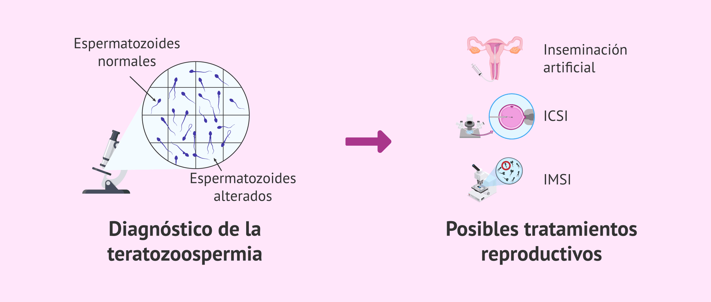 Imagen: Opciones reproductivas para varones con teratozoospermia